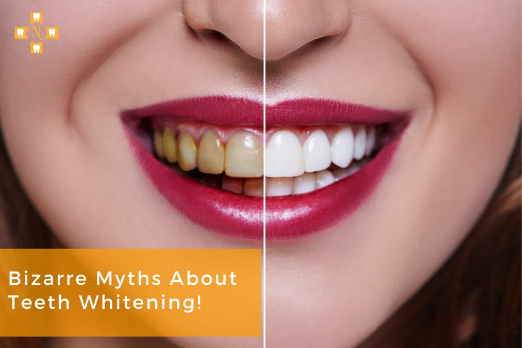 Teeth Whitening