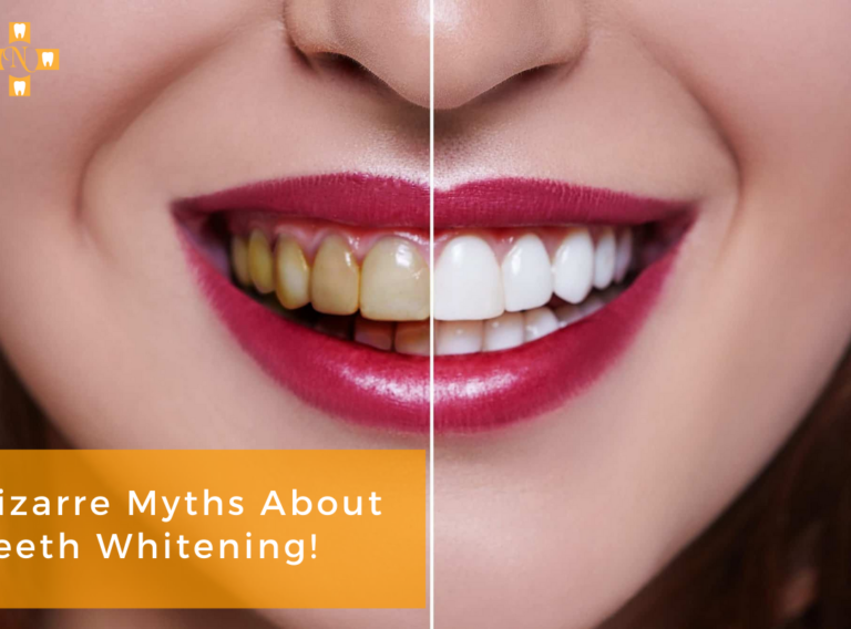 Teeth Whitening